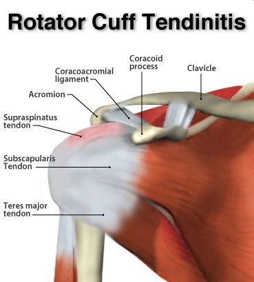 Rotator Cuff Tendinitis Pictures