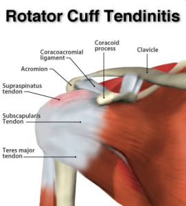 rotator-cuff-tendinitis