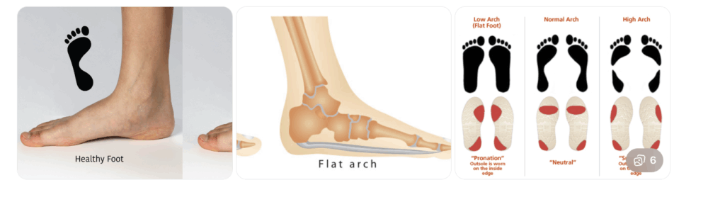 markham orthotics for flat feet