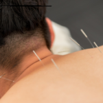 Acupuncture in Markham
