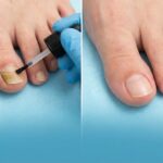 Nail Fungus Removal